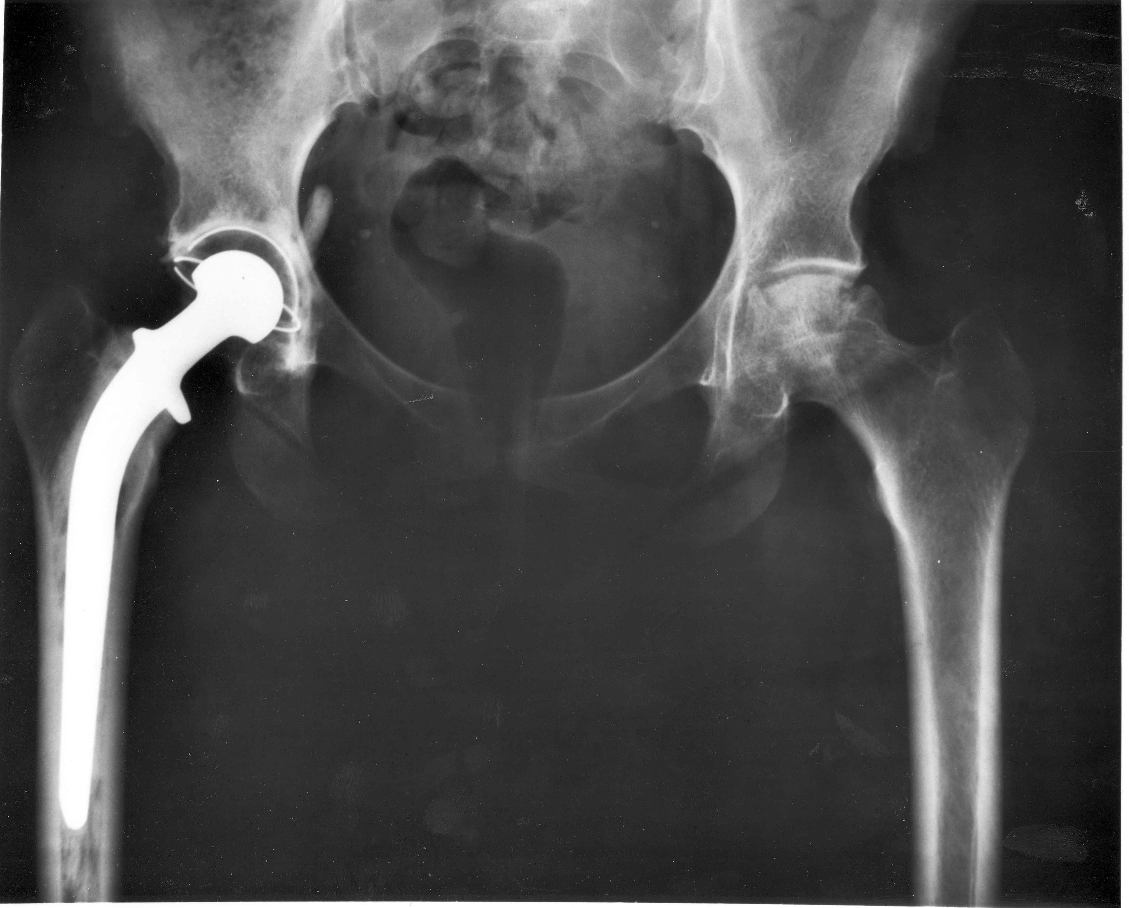 Osteoporosis Treatment Should Be Matched to Fracture Risk, Not Bone Density Alone