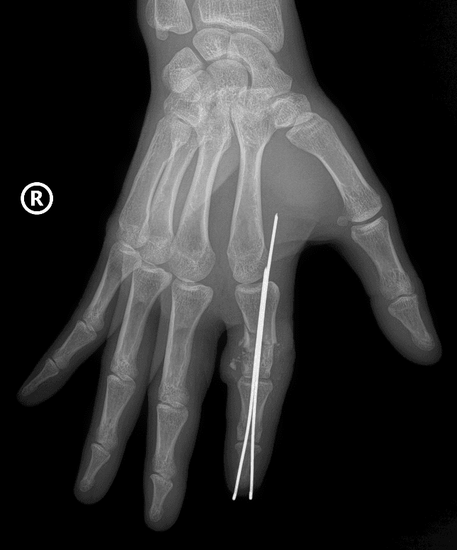 Upadacitinib Can Achieve Strong Disease Control Early in Rheumatoid Arthritis