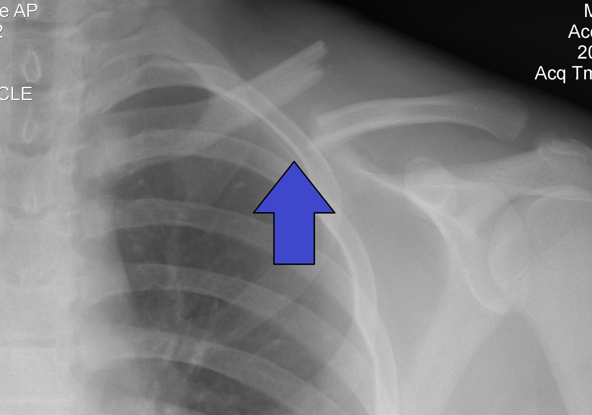 Plate Fixation Reduces Nonunion Risk in Displaced Midshaft Clavicle Fractures—But the Functional Gain Is Modest