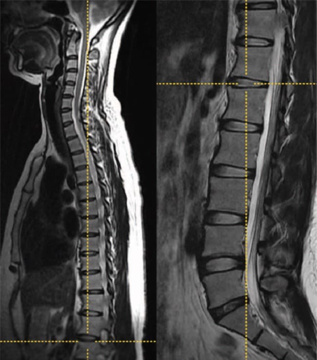 Randomized Evidence Supports Surgery for Selected Symptomatic Lumbar Spinal Stenosis