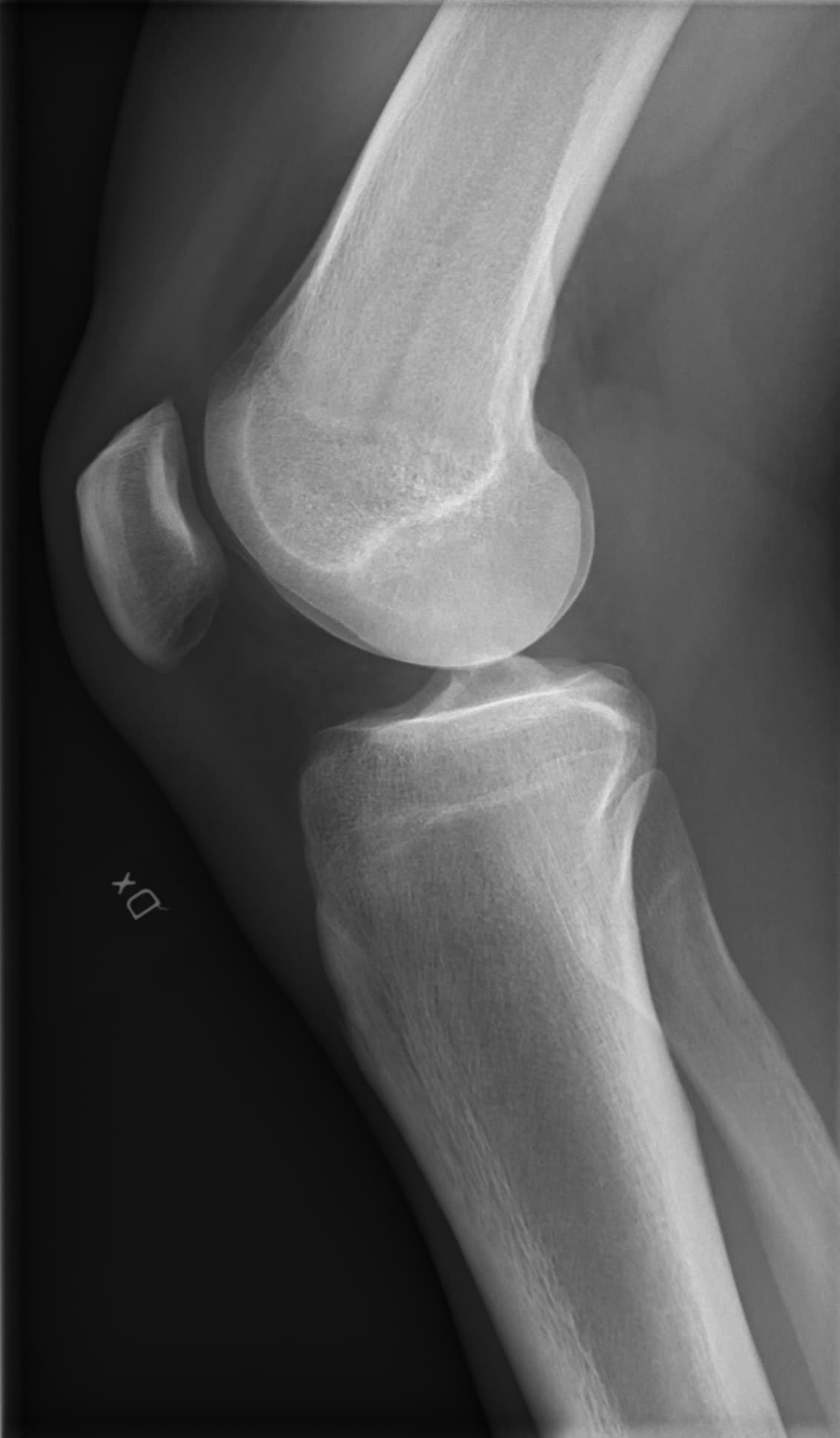 Young First-Time Shoulder Dislocators May Benefit From Early Arthroscopic Stabilisation