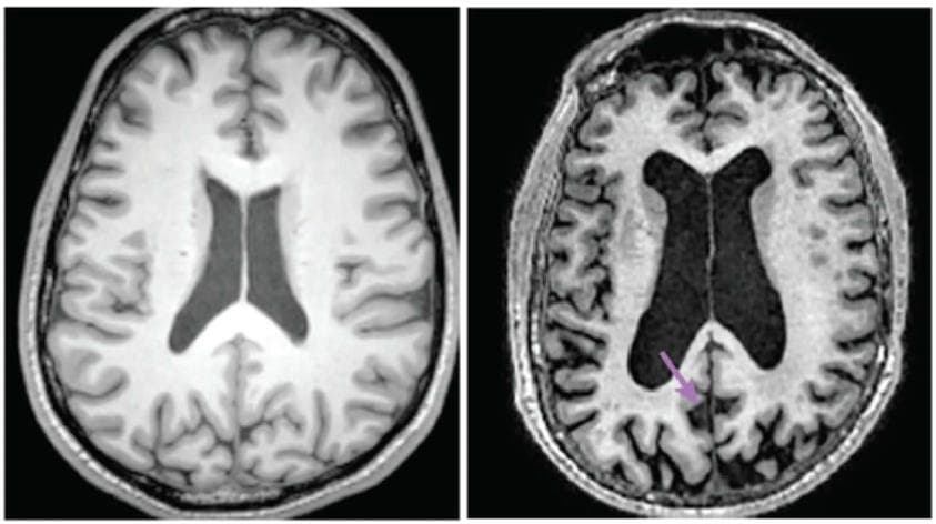Lecanemab Modestly Slows Clinical Decline in Early Alzheimer Disease but Requires Safety Monitoring