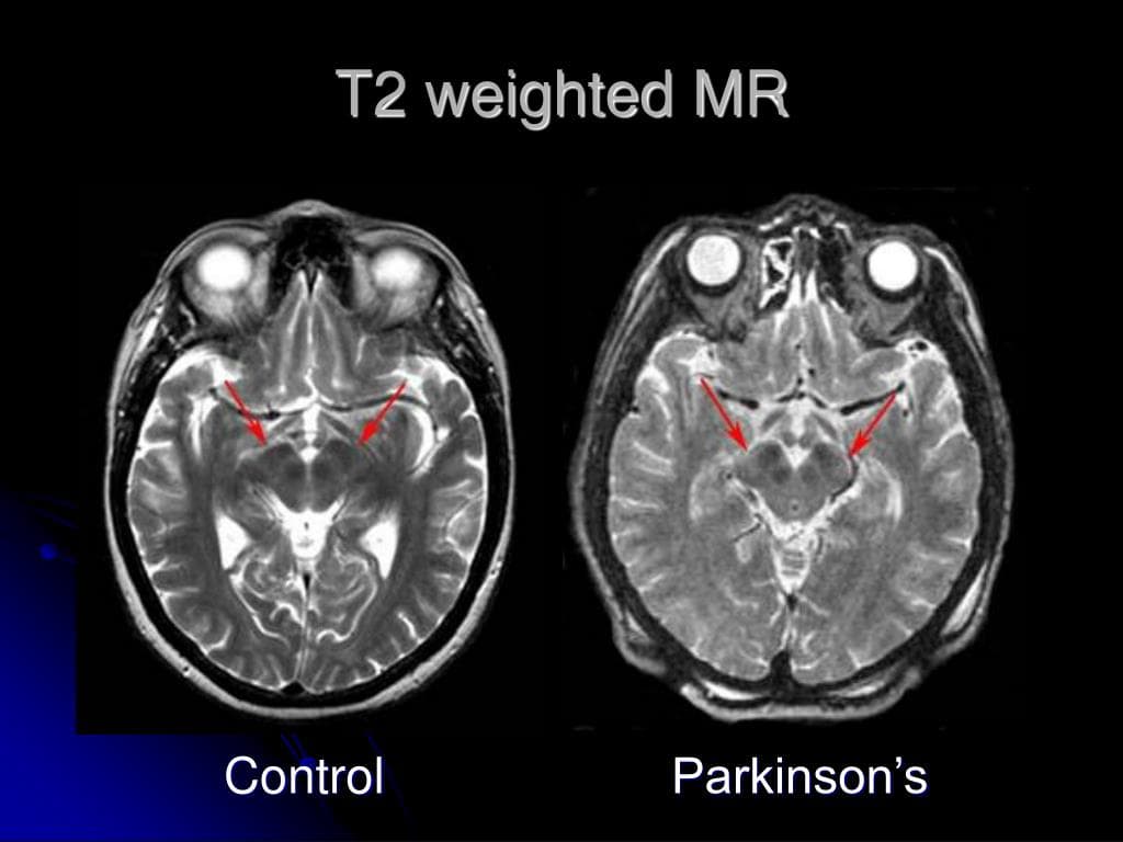 Galcanezumab Shows Placebo-Controlled Benefit in Vestibular Migraine