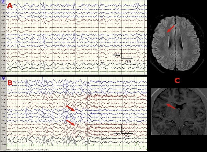 Vagus Nerve Stimulation Can Reduce Seizure Frequency in Drug-Resistant Epilepsy