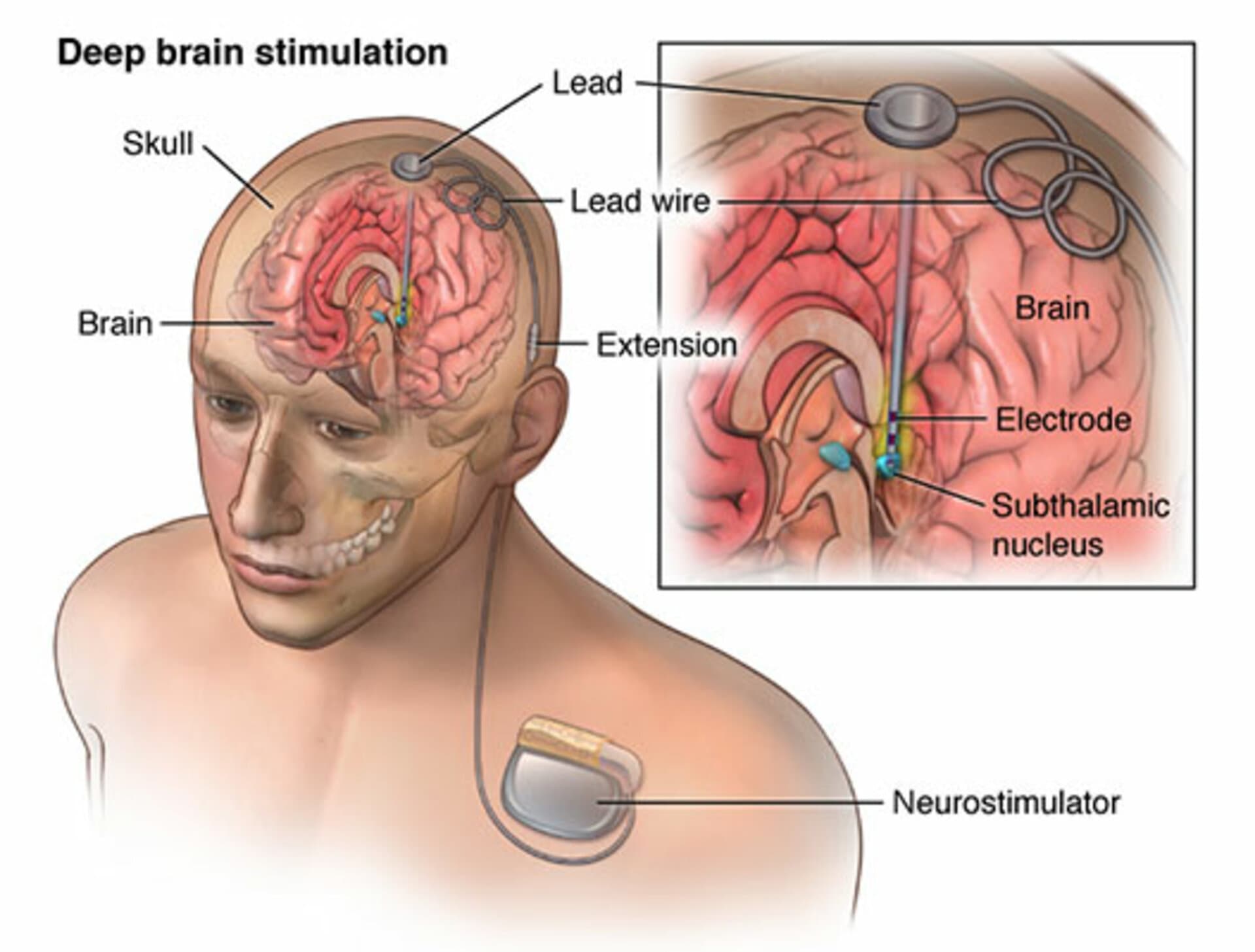 STN and GPi Deep Brain Stimulation Both Improve Advanced Parkinson Motor Symptoms