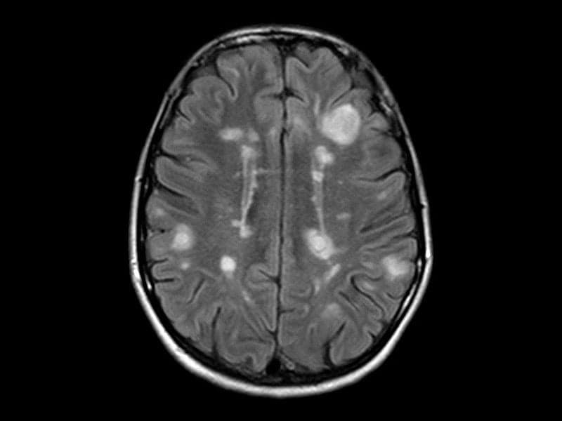Siponimod Reduced Disability Progression in Secondary Progressive MS
