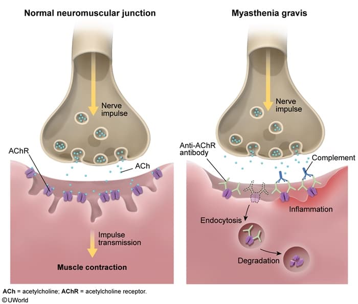 Efgartigimod Produces Clinically Meaningful Improvement in Generalized Myasthenia Gravis