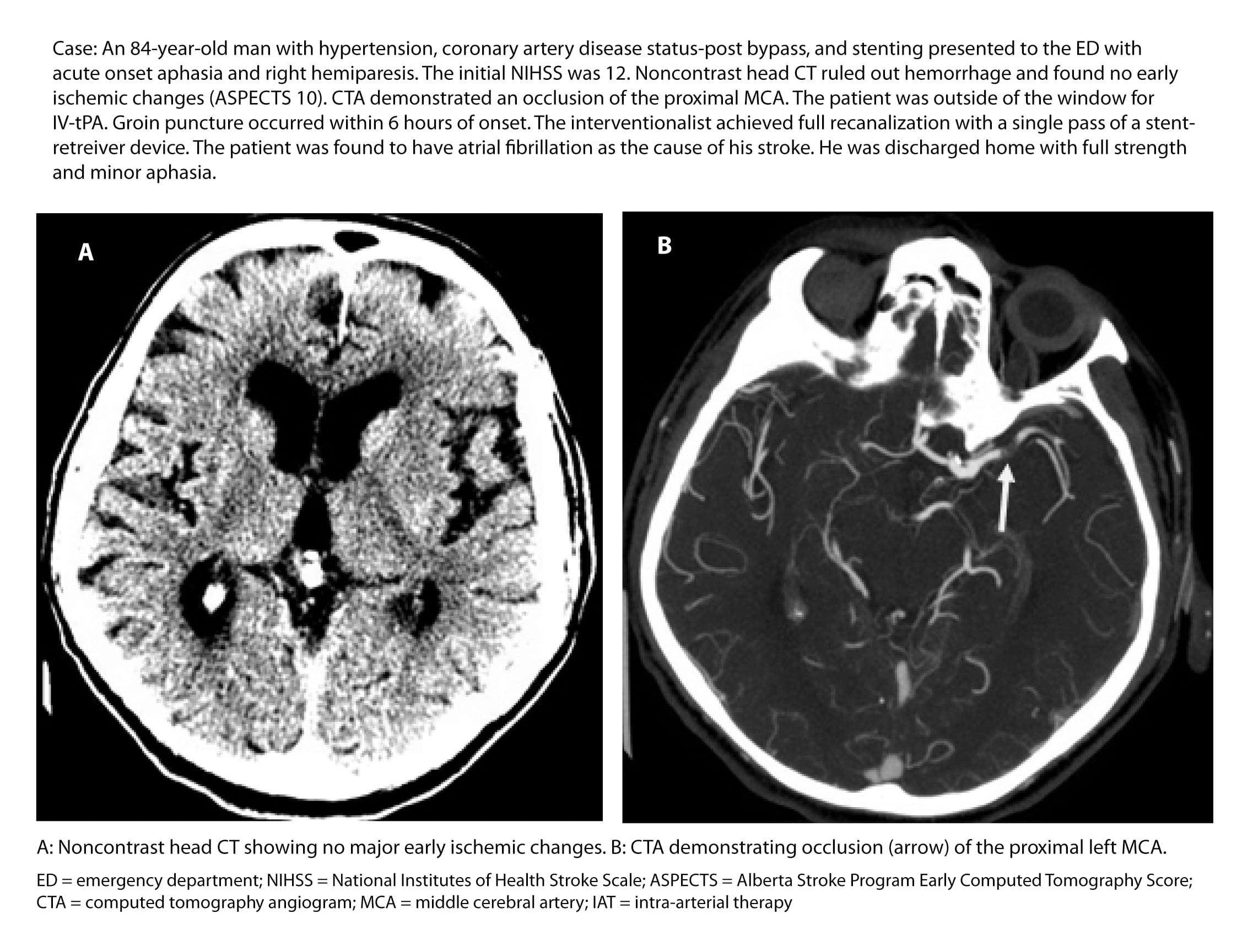 Large-Core Stroke Is No Longer an Automatic Exclusion From Thrombectomy
