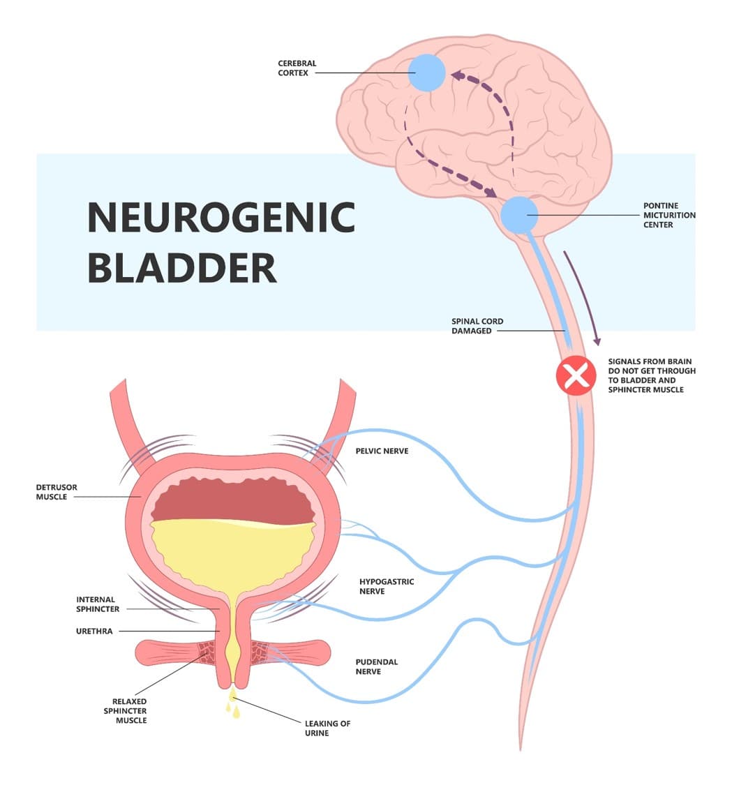 Botulinum Toxin Therapy Can Be Used as Part of a Long-Term Neuro-Urology Strategy