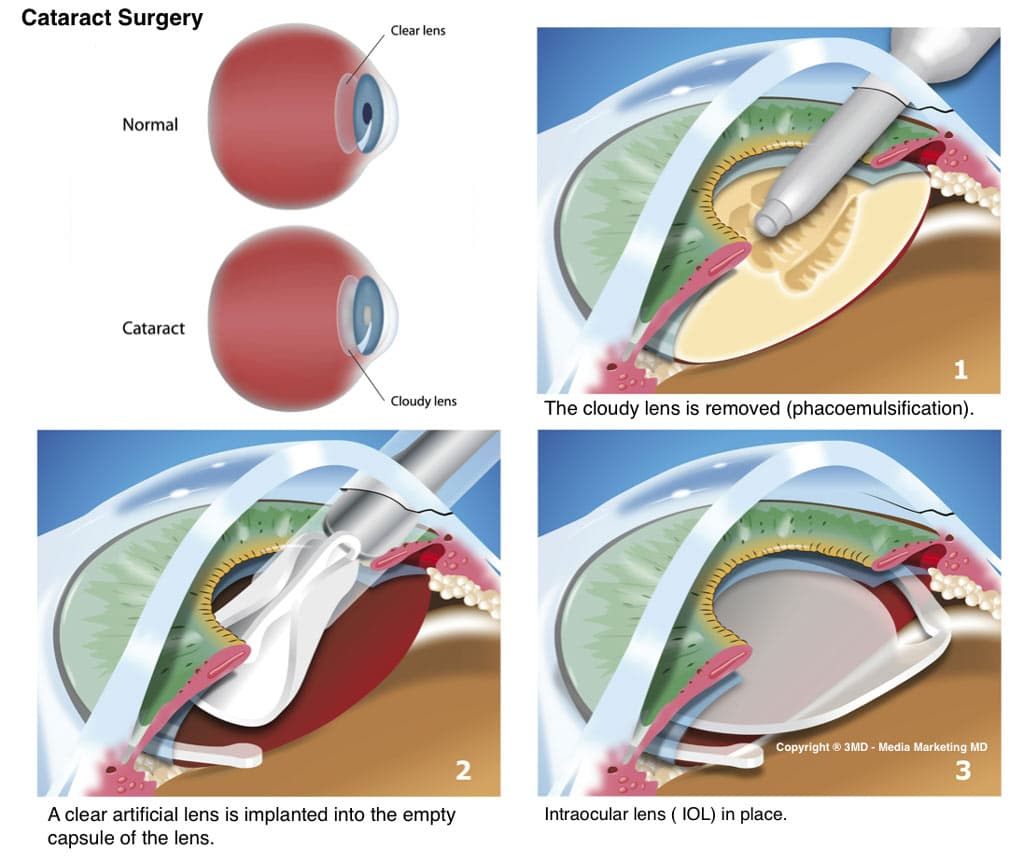 Posterior Capsule Rupture Risk Is Higher in Complex Cataract Profiles