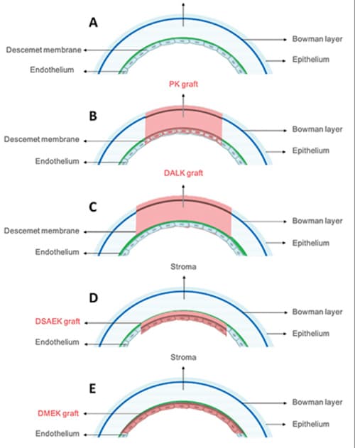 Clinical Trial Data Support DALK as a Viable Alternative to PK in Keratoconus