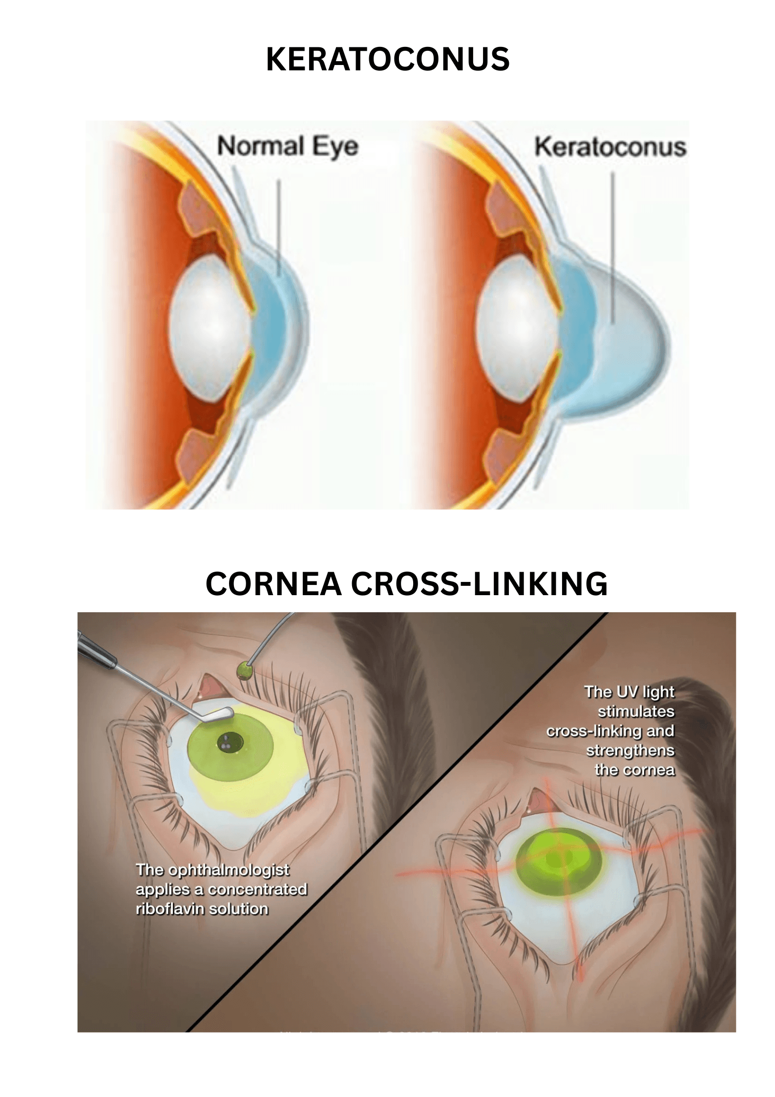 PACK-CXL Shows Promise in Infectious Keratitis, but Evidence Quality Remains Limited