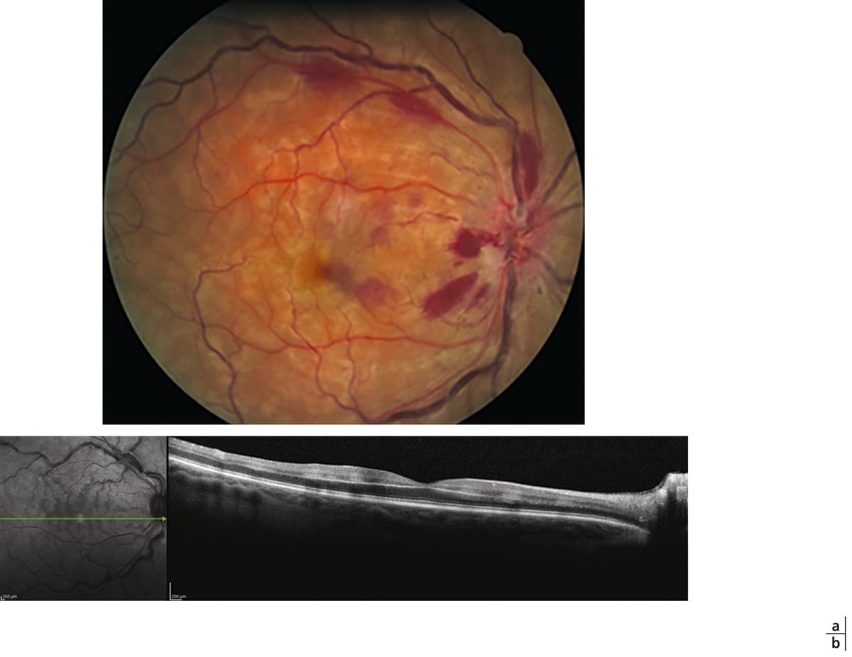 Aflibercept Produces Strong Visual Gains in Macular Edema After Branch Retinal Vein Occlusion