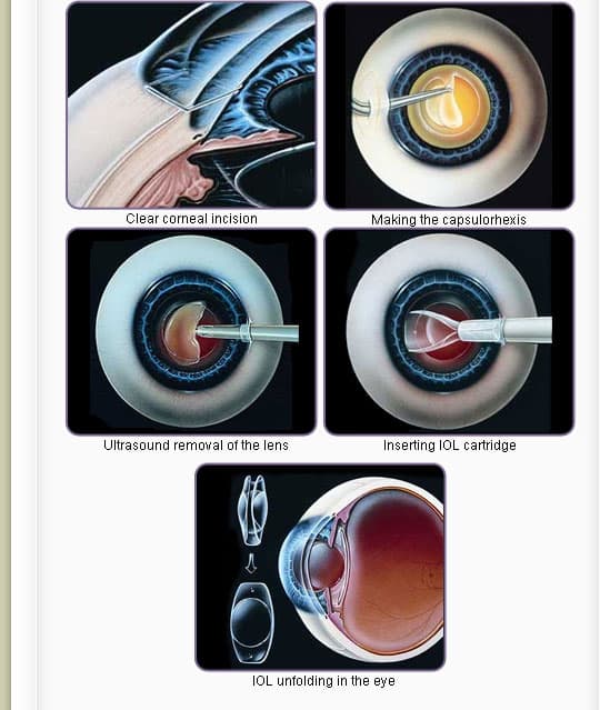 FLACS and Conventional Phaco Deliver Similar Long-Term Vision