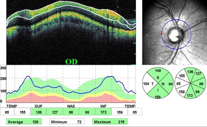 PTVT Five-Year Data Show Similar IOP With Tube Shunts and Trabeculectomy