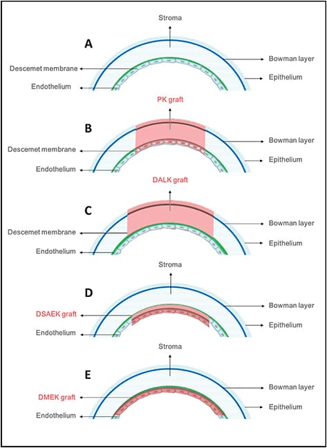 Ultrathin DSAEK Can Match Standard DSAEK With a Thinner Donor Graft