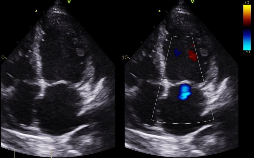 Empagliflozin Reduced Heart-Failure Hospitalization Across the Ejection-Fraction Spectrum