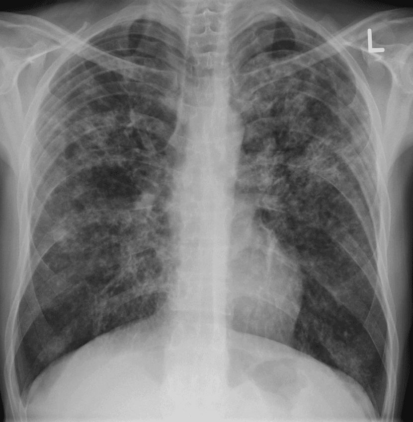 Reducing Linezolid Exposure Can Preserve the Efficacy of BPaL-Based TB Treatment