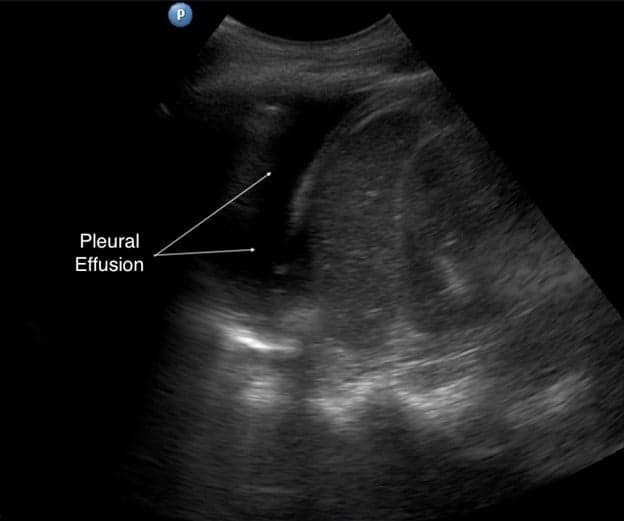 Medical Thoracoscopy Provides a High-Yield Route to the Cause of Undiagnosed Pleural Effusion