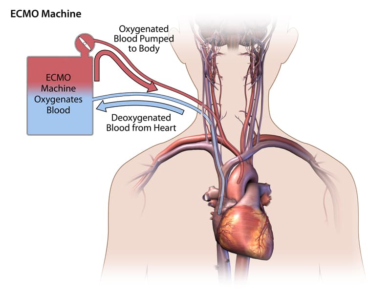 ECMO for Severe ARDS: Not a Universal Answer, but a Strategy for Selected Patients