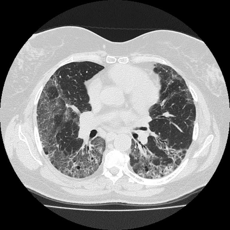 Nintedanib Slowed FVC Decline in Idiopathic Pulmonary Fibrosis