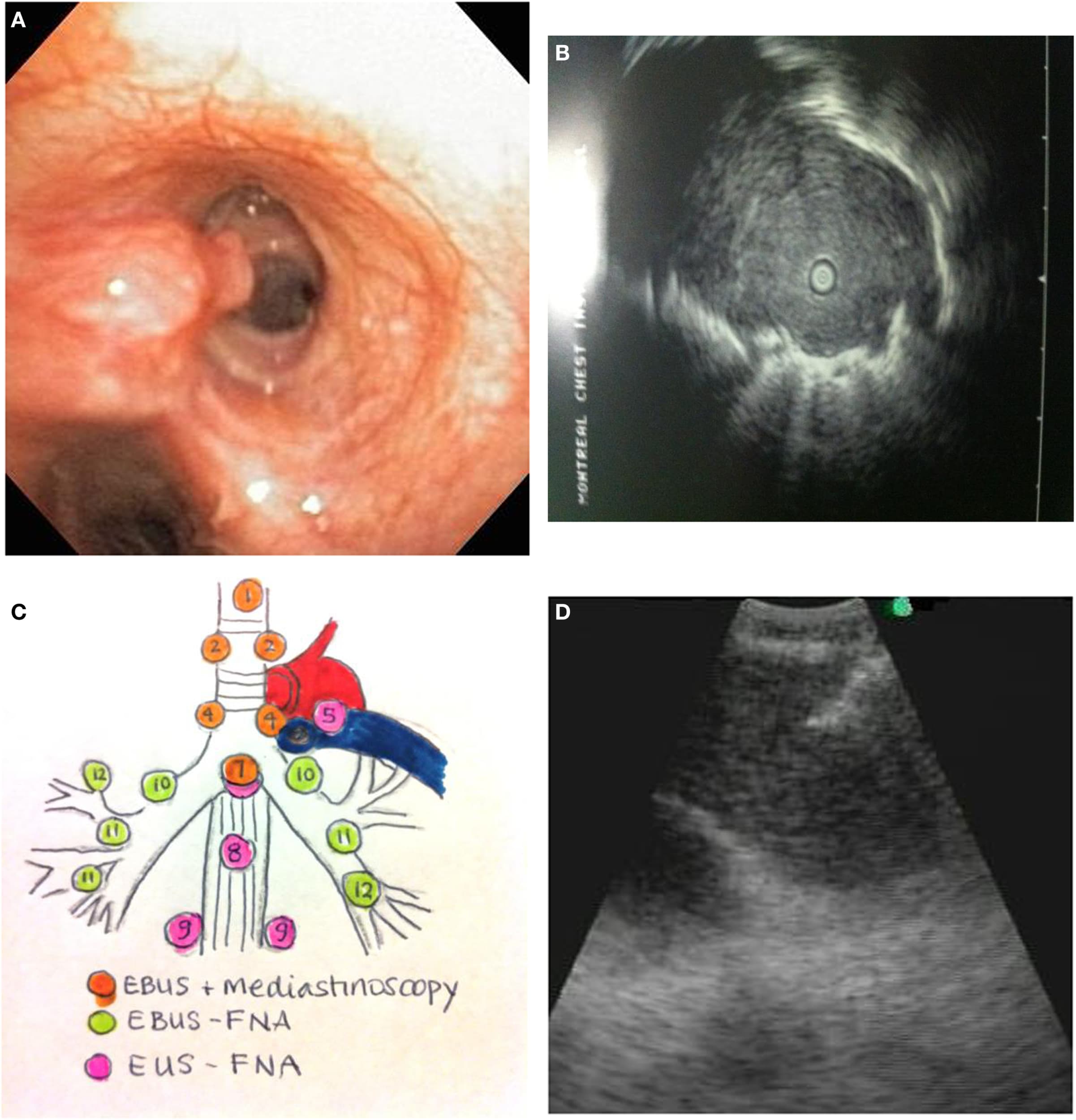 Biomarker-Driven Osimertinib Extended Disease Control in EGFR-Mutated Lung Cancer
