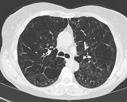 KRONOS Showed Triple Therapy Can Improve Lung Function Beyond Dual Therapy