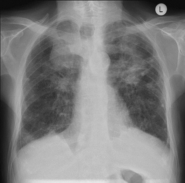 Silicosis Remains a Major Occupational Lung Problem in India