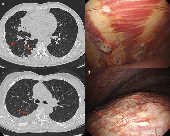Indwelling Pleural Catheters Can Reduce Hospital Days in Malignant Pleural Effusion