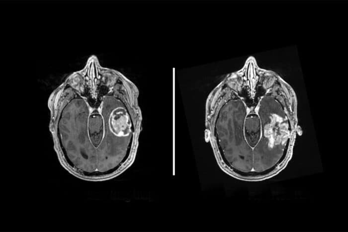 Nivolumab Plus Ipilimumab Activates Immunity in Recurrent Glioblastoma