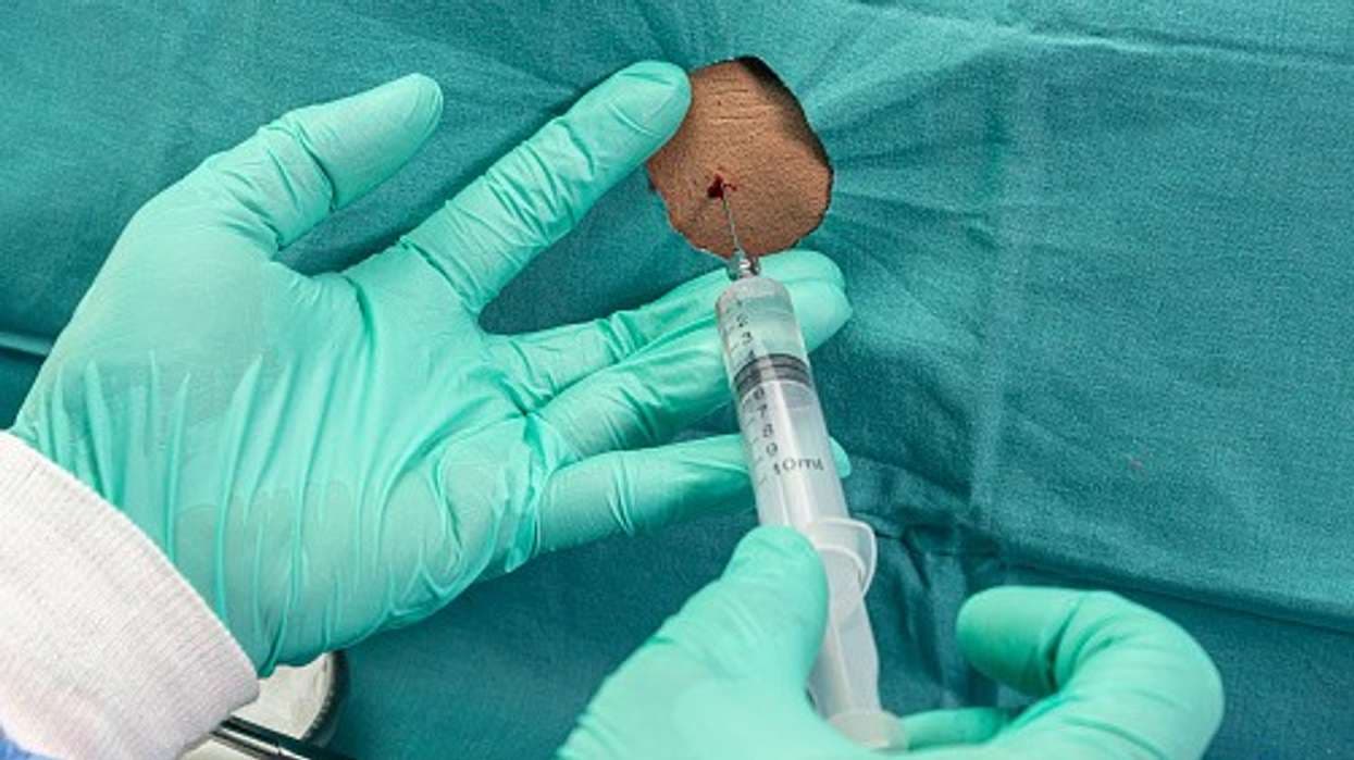 Tofersen Safety Profile Characterized in Systematic Review and Meta-Analysis