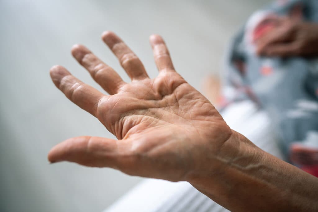 Tavapadon Improves Motor Symptoms in Early Parkinson's Disease