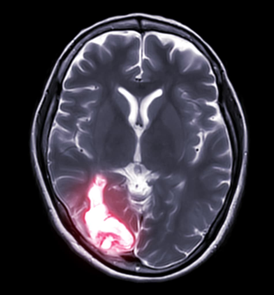 Focused Ultrasound Shows Potential for Seizure Reduction in Drug-Resistant Epilepsy