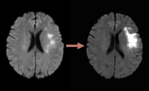 Argatroban for early neurological deterioration after ischemic stroke