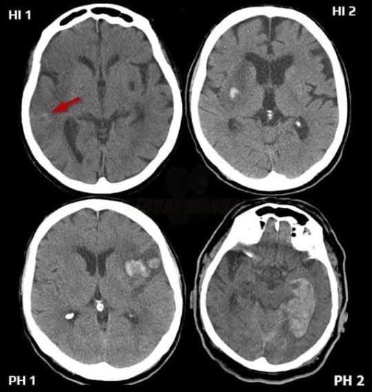 Clopidogrel plus aspirin for acute mild-to-moderate ischemic stroke