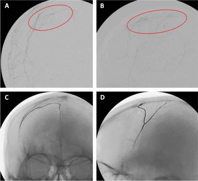 EMBOLISE trial: Middle meningeal artery embolization