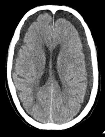 STEM trial: Embolization for chronic subdural hematoma