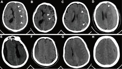 MAGIC-MT trial: Embolization for nonacute subdural hematoma