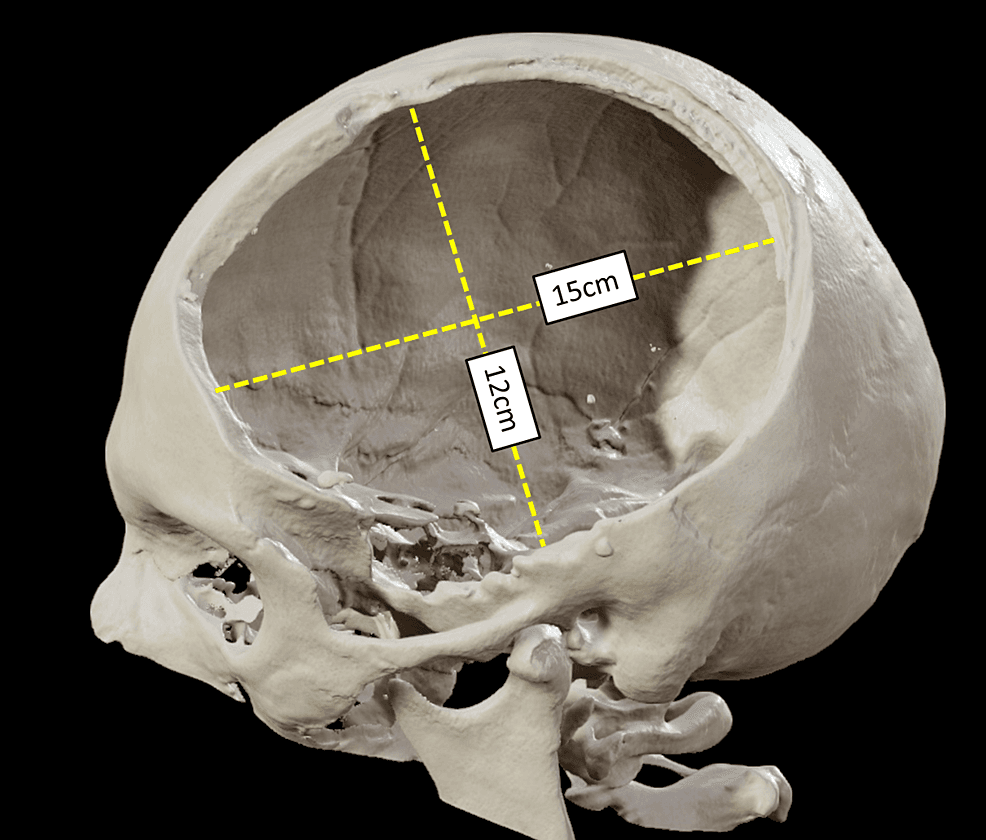 PREDICT-AEDH trial: Decompressive craniectomy versus craniotomy