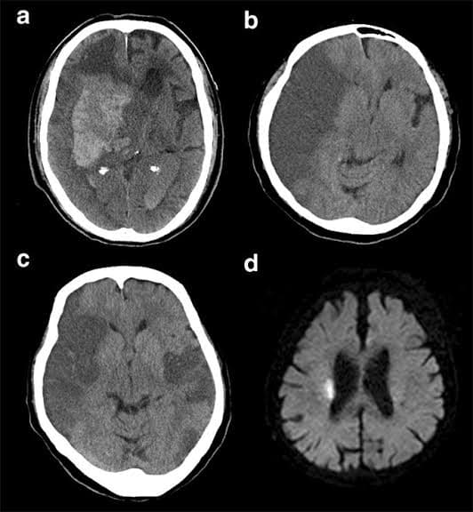 Low-dose ticagrelor plus aspirin for early neurological deterioration