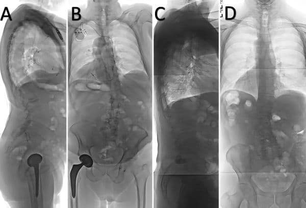 Five-Year Outcomes of Minimally Invasive Lumbar Fusion Versus Decompression Alone