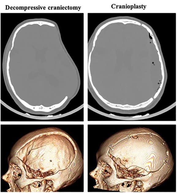 Long-Term Outcomes and Complications Following Cranioplasty After Decompressive Craniectomy