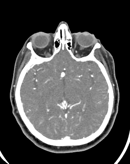 Clinical and Angiographic Outcomes of FRED X Flow Diversion for Intracranial Aneurysms