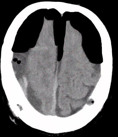 Is Intraoperative Irrigation Necessary During Burr-Hole Evacuation of Chronic Subdural Hematoma?