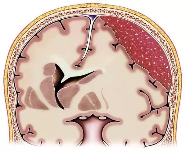Middle meningeal artery embolization after surgery for chronic subdural hematoma