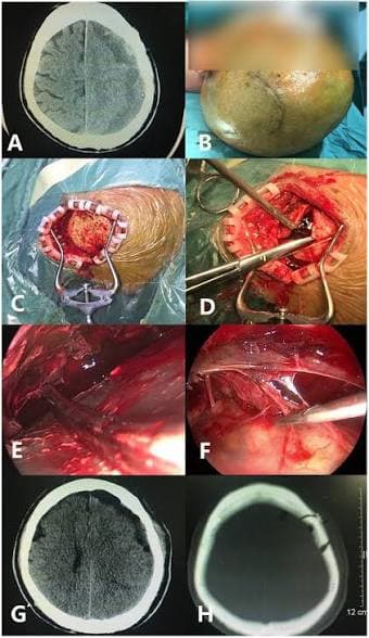 Endoscopic membranectomy versus craniotomy for non-homogeneous chronic subdural hematoma