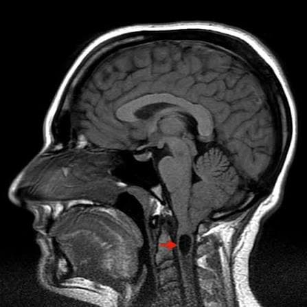 Comparative Outcomes of Decompression Techniques for Chiari I Malformation With Syringomyelia