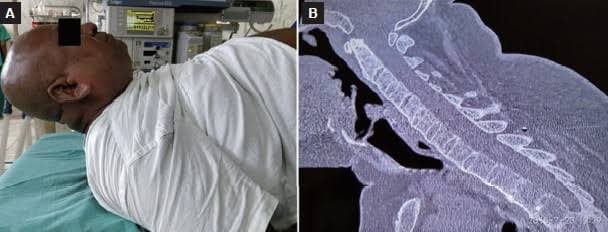 Comparative Efficacy and Safety of Dexmedetomidine-Based and Fentanyl-Based Analgesia in Craniotomy