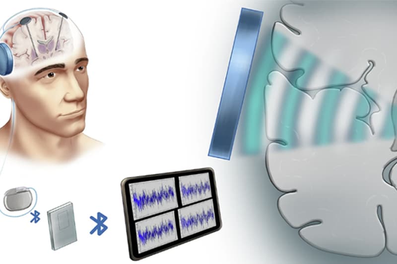Disease State Influences Focused Ultrasound Neuromodulation in Parkinson’s Models