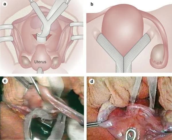 Management strategies for stress urinary incontinence during POP surgery